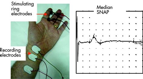 sensory nerve conduction test